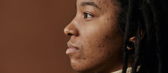 Young lady with problematic skin showing pimples and redness