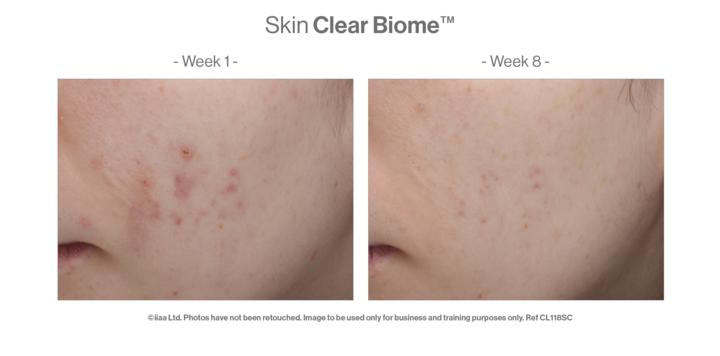 Skin Clear Biome case study: before and after imagery