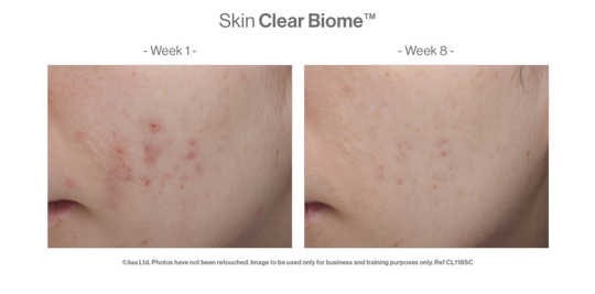 Skin Clear Biome Before & After Client Results