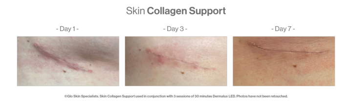 Skin Collagen Support case study: before and after imagery