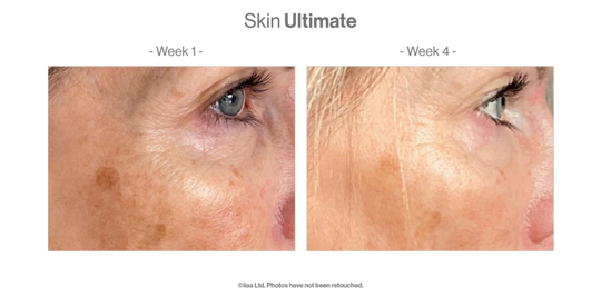 Skin Ultimate client before and after results